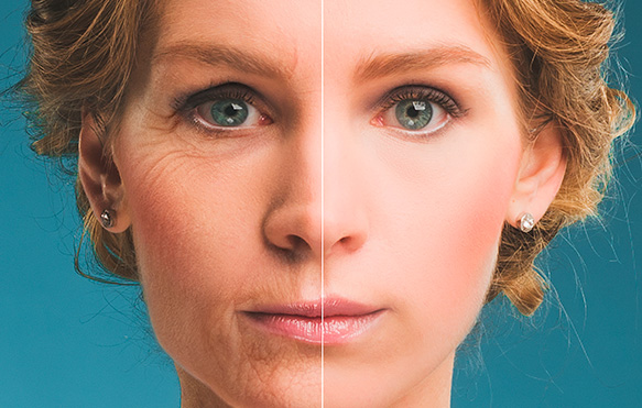 Botox Botox