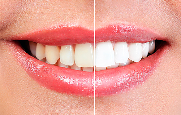Clareamento Dental Clareamento Dental